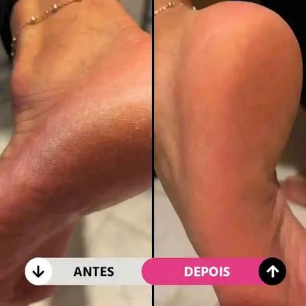 ✨ ¡Despídete de los talones agrietados y luce unos pies suaves en minutos!
